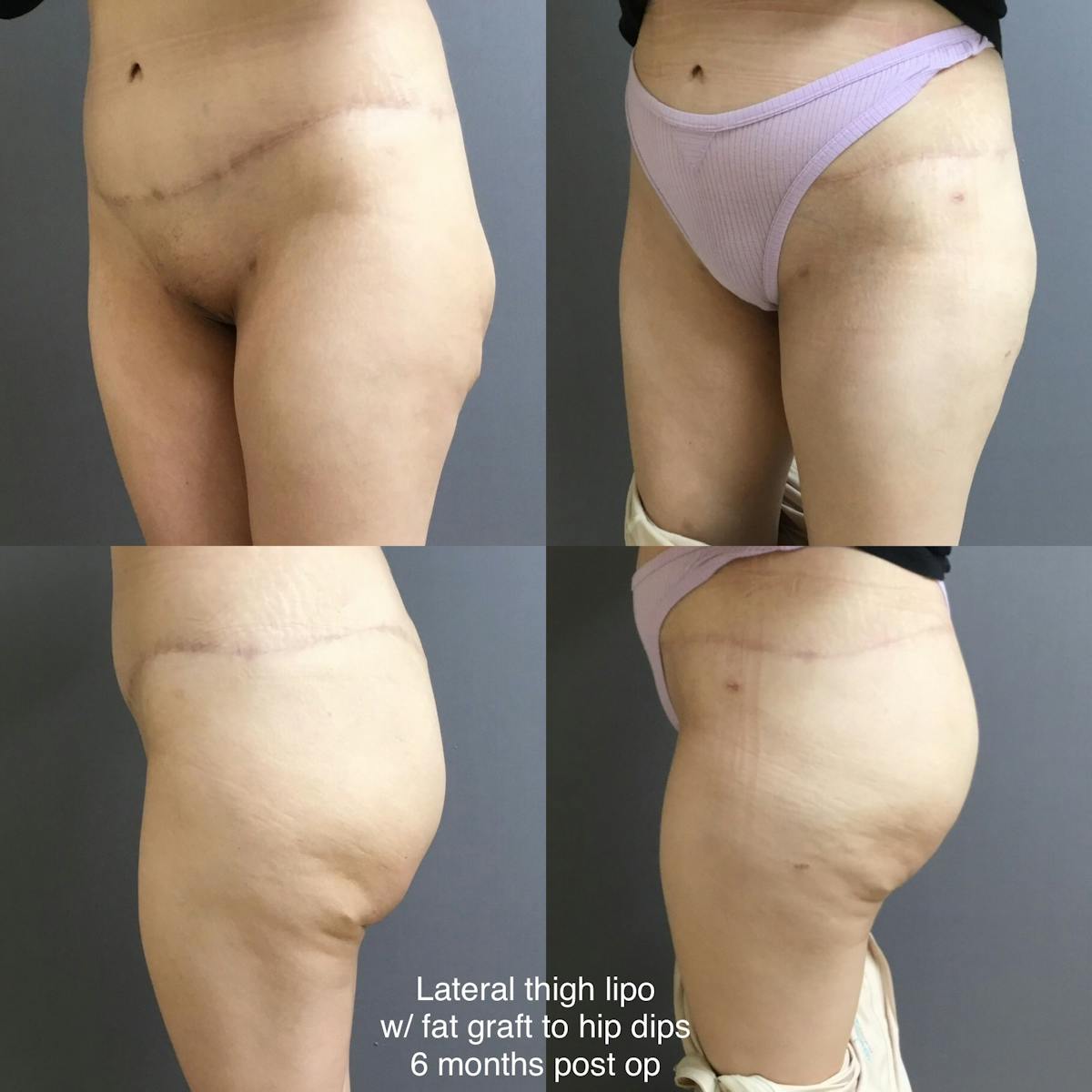 Liposuction Before & After Gallery - Patient 329455 - Image 1