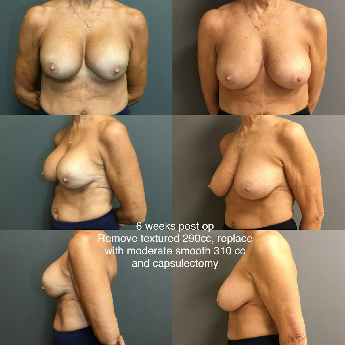 Re and Re Before & After Gallery - Patient 316039 - Image 1