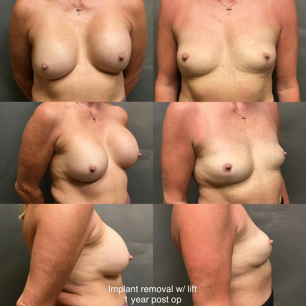 Removal-Lift Before & After Gallery - Patient 207676 - Image 1