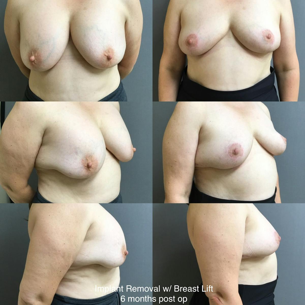 Removal-Lift Before & After Gallery - Patient 321082 - Image 1