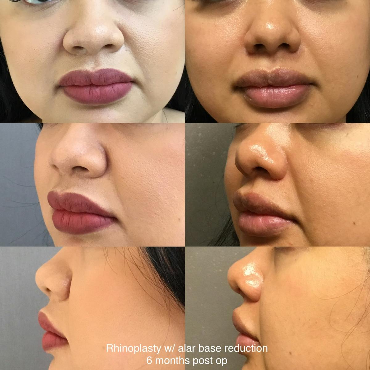 Rhinoplasty Before & After Gallery - Patient 315341 - Image 1