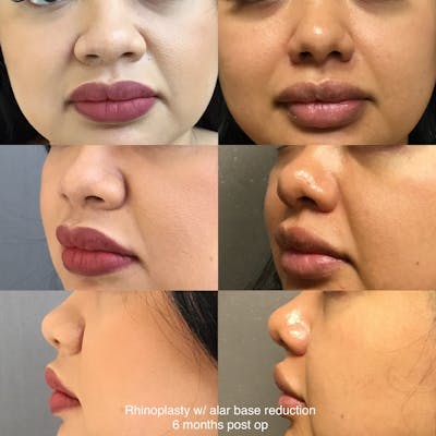 Rhinoplasty Before & After Gallery - Patient 315341 - Image 1
