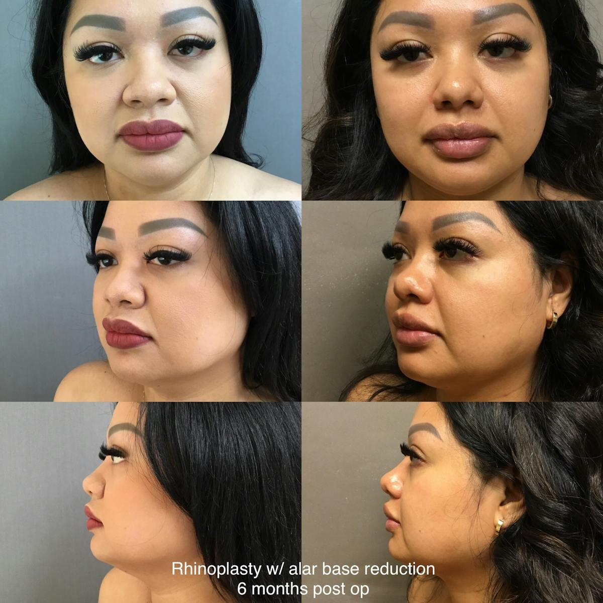 Rhinoplasty Before & After Gallery - Patient 829622 - Image 1