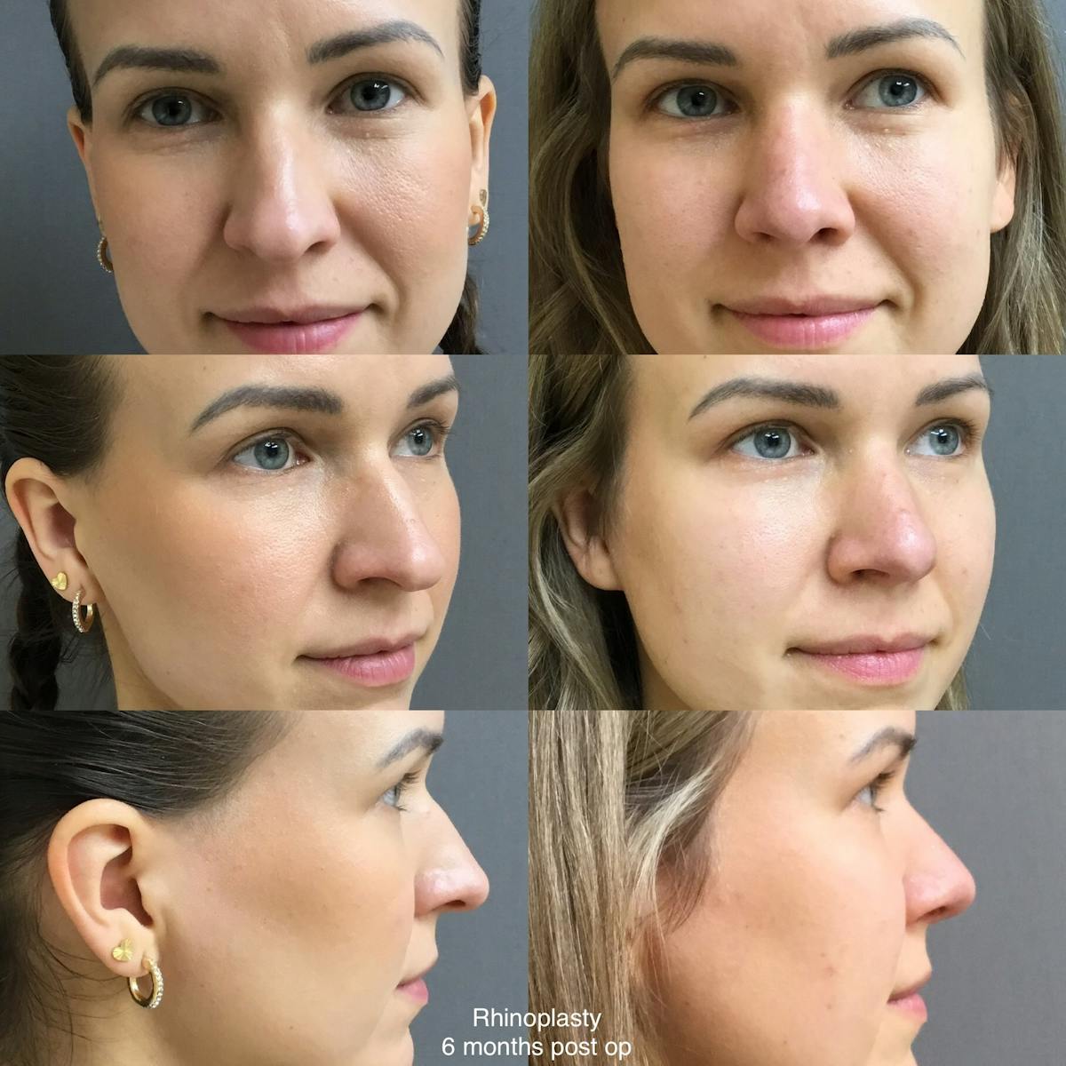 Rhinoplasty Before & After Gallery - Patient 267035 - Image 1