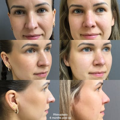 Rhinoplasty Before & After Gallery - Patient 267035 - Image 1