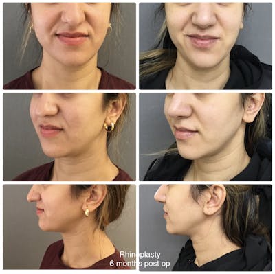 Rhinoplasty Before & After Gallery - Patient 576178 - Image 1