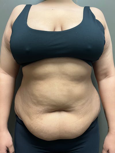 Abdominoplasty Before & After Gallery - Patient 336396 - Image 1