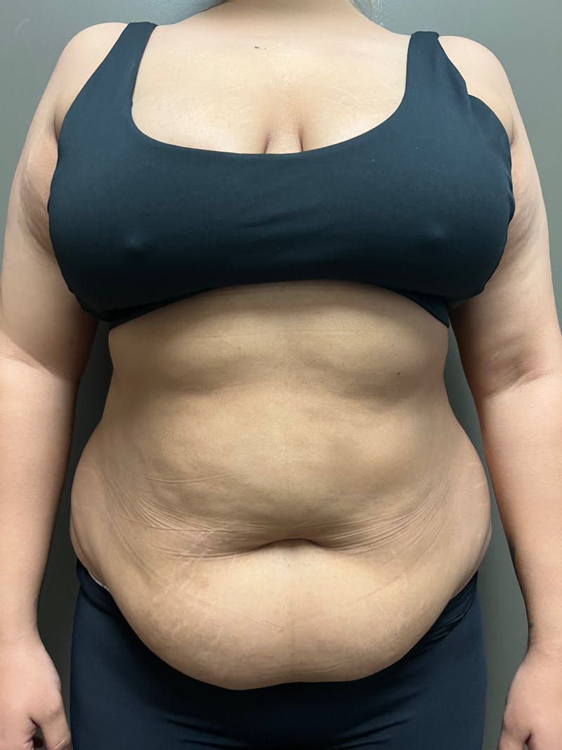 Abdominoplasty Before & After Gallery - Patient 336396 - Image 1