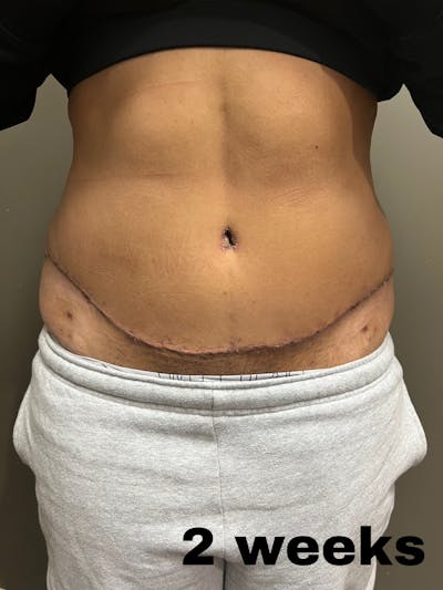 Abdominoplasty Before & After Gallery - Patient 336396 - Image 2
