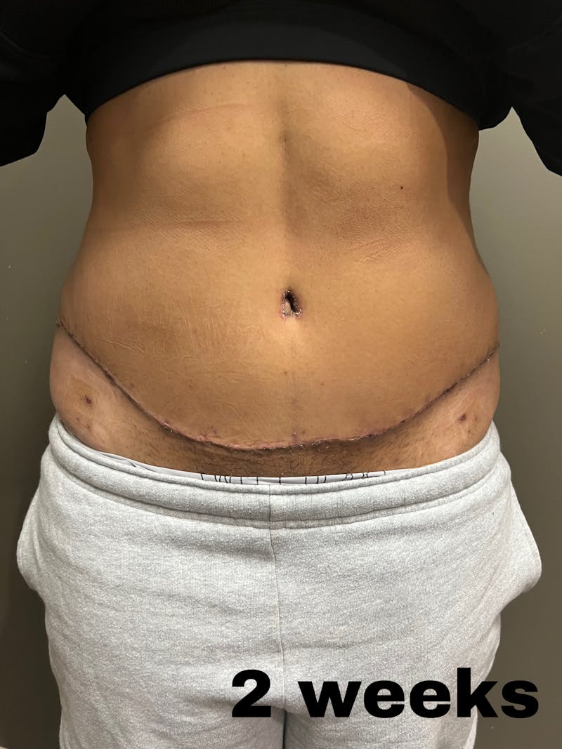 Abdominoplasty Before & After Gallery - Patient 336396 - Image 2