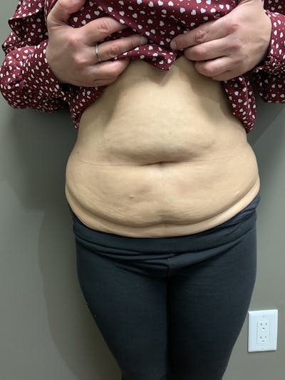 Abdominoplasty Before & After Gallery - Patient 285292 - Image 1