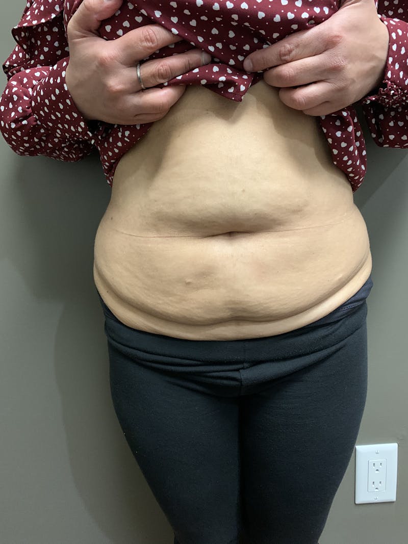 Abdominoplasty Before & After Gallery - Patient 285292 - Image 1