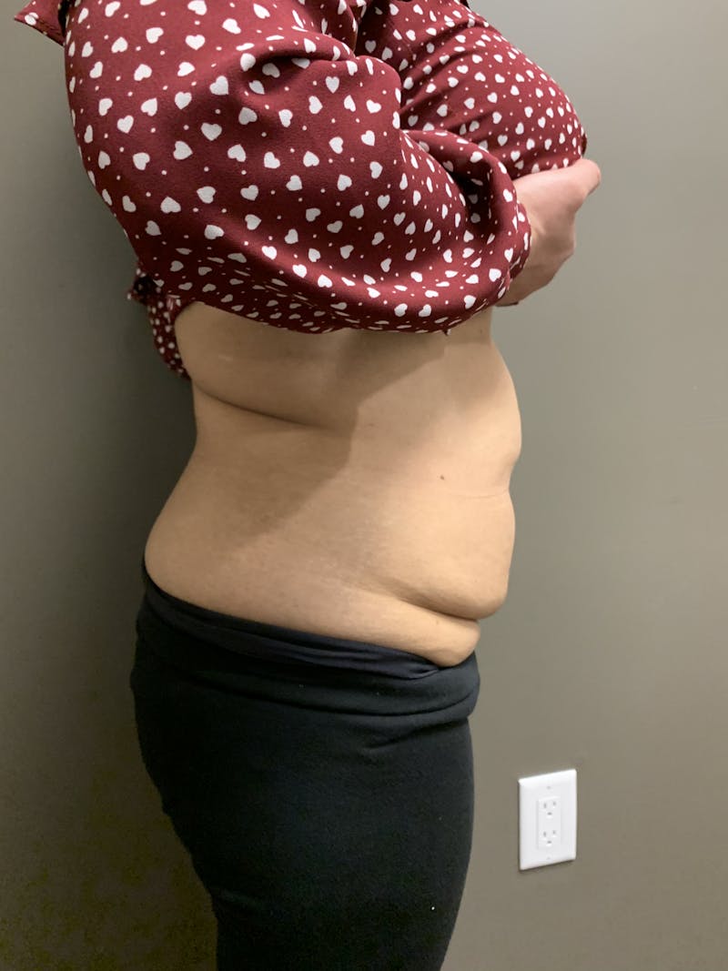 Abdominoplasty Before & After Gallery - Patient 285292 - Image 3