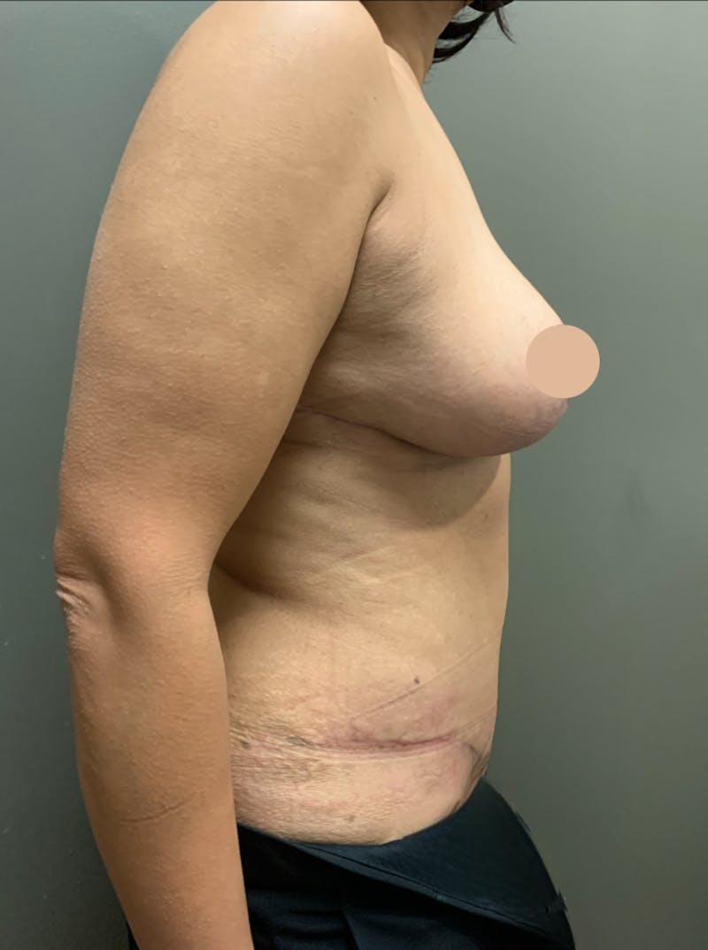 Abdominoplasty Before & After Gallery - Patient 285292 - Image 4