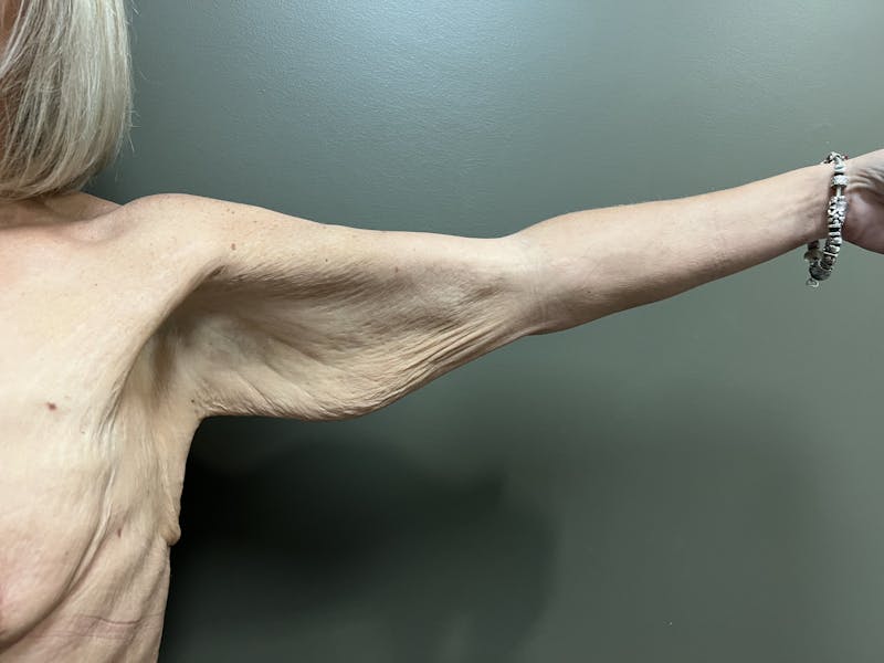 Arm Lift (Brachioplasty) Before & After Gallery - Patient 100603 - Image 1