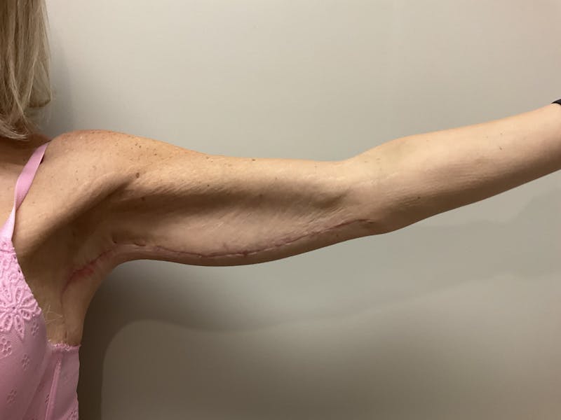 Arm Lift (Brachioplasty) Before & After Gallery - Patient 100603 - Image 2