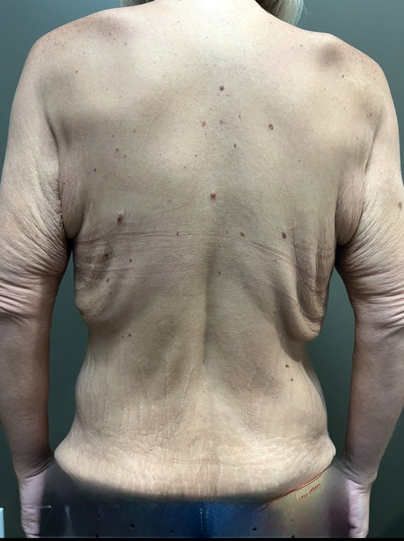 Bra Line Upper Back Lift Before & After Gallery - Patient 324971 - Image 1
