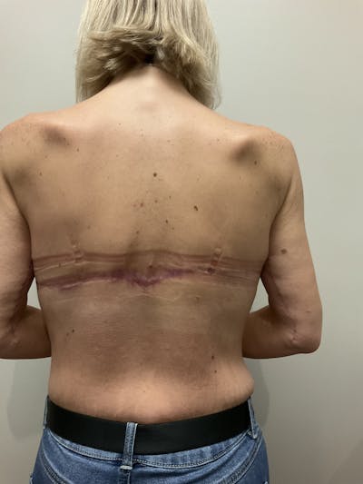 Bra Line Upper Back Lift Before & After Gallery - Patient 324971 - Image 2