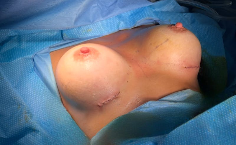 Breast Augmentation Before & After Gallery - Patient 390918 - Image 2