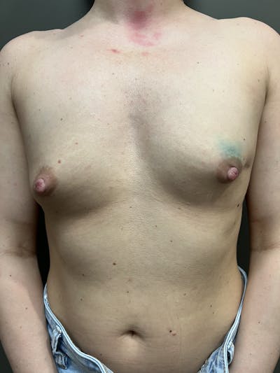 Implant-Based Alloplastic Breast Reconstruction Before & After Gallery - Patient 428792 - Image 1