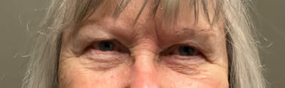 Lower Eyelid Blepharoplasty  Before & After Gallery - Patient 334342 - Image 1
