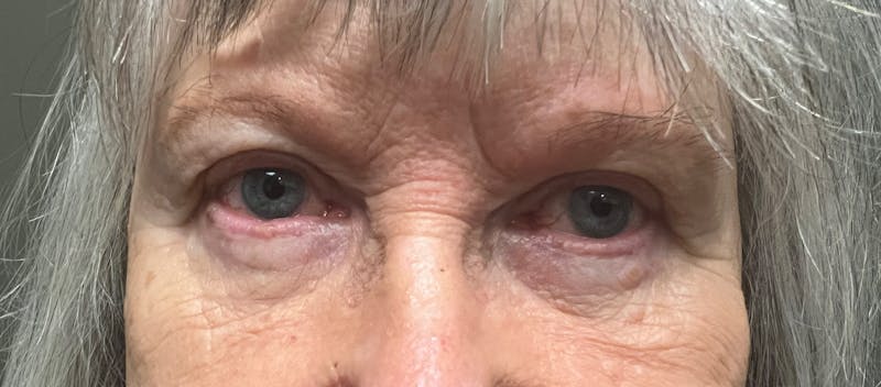 Lower Eyelid Blepharoplasty  Before & After Gallery - Patient 334342 - Image 2