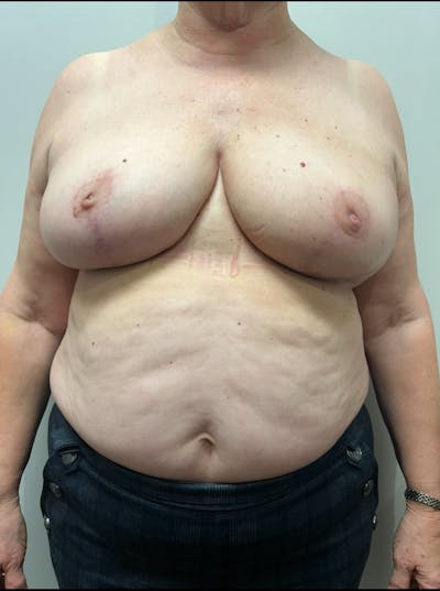 Oncoplastic Breast Reduction Before & After Gallery - Patient 225791 - Image 2