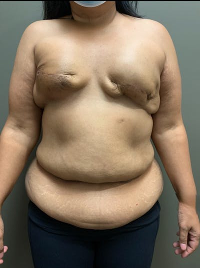 Own-Tissue Autologous Breast Reconstruction Before & After Gallery - Patient 355803 - Image 1