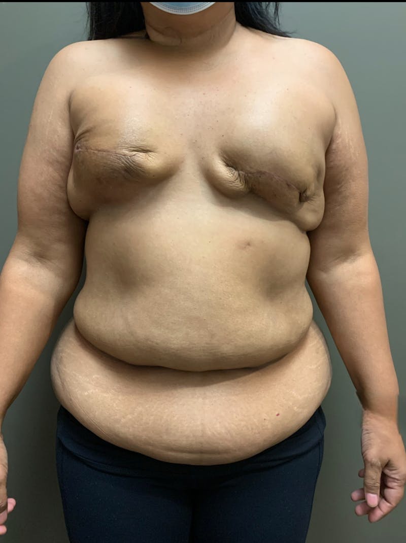 Own-Tissue Autologous Breast Reconstruction Before & After Gallery - Patient 355803 - Image 1