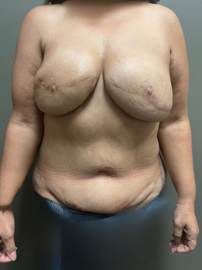 Own-Tissue Autologous Breast Reconstruction Before & After Gallery - Patient 355803 - Image 2
