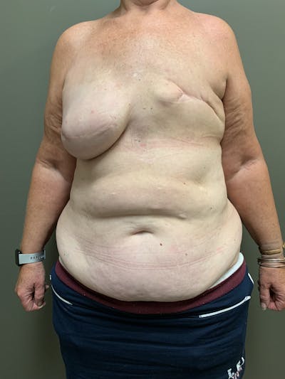 Own-Tissue Autologous Breast Reconstruction Before & After Gallery - Patient 911100 - Image 1