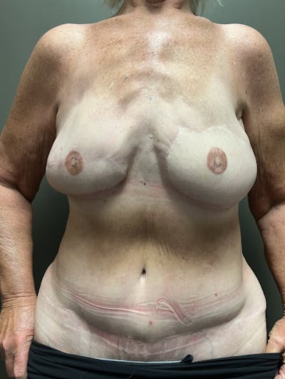 Own-Tissue Autologous Breast Reconstruction Before & After Gallery - Patient 911100 - Image 2