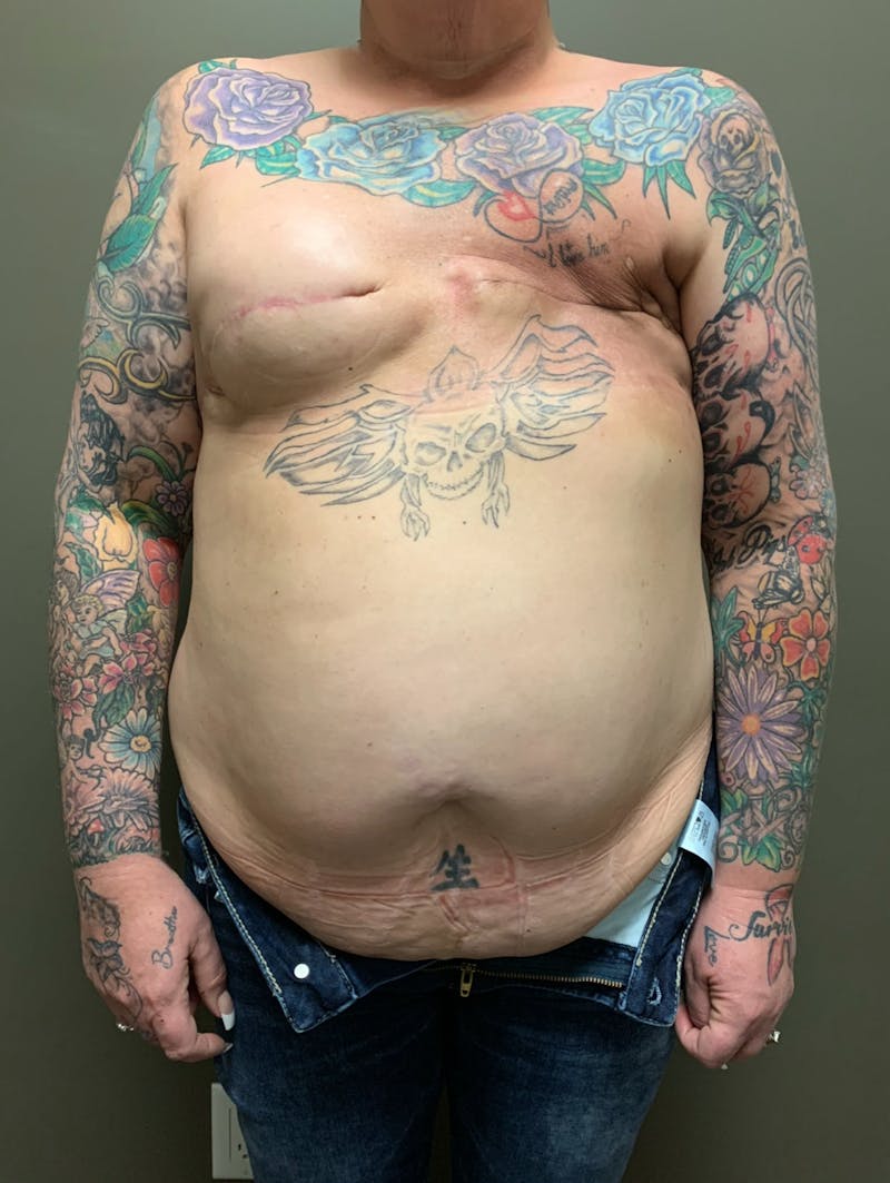 Own-Tissue Autologous Breast Reconstruction Before & After Gallery - Patient 203100 - Image 1