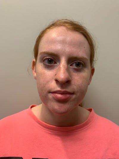 Rhinoplasty Before & After Gallery - Patient 221782 - Image 1