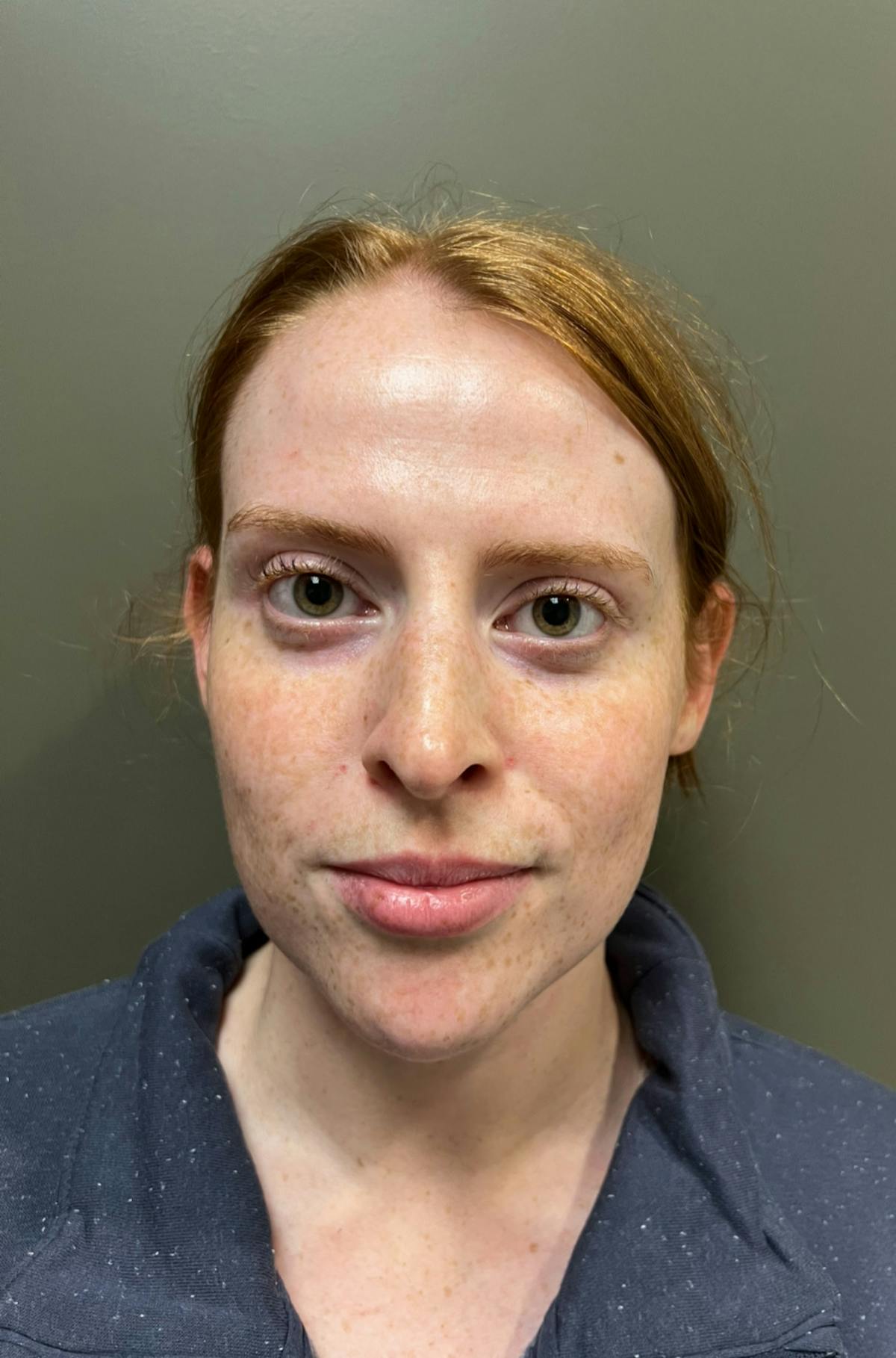 Rhinoplasty Before & After Gallery - Patient 221782 - Image 2