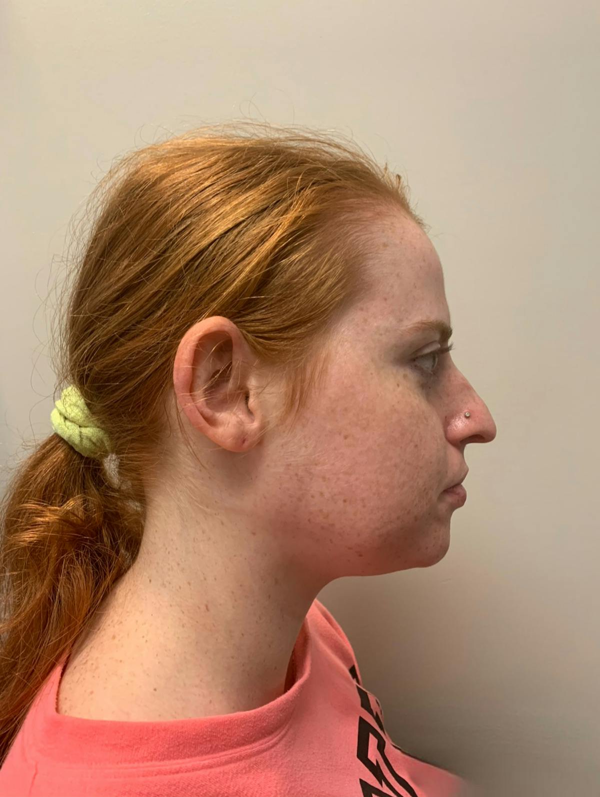 Rhinoplasty Before & After Gallery - Patient 221782 - Image 3