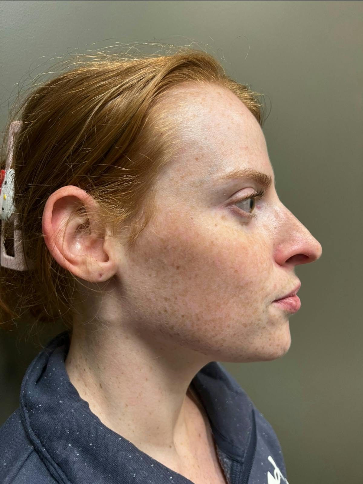 Rhinoplasty Before & After Gallery - Patient 221782 - Image 4