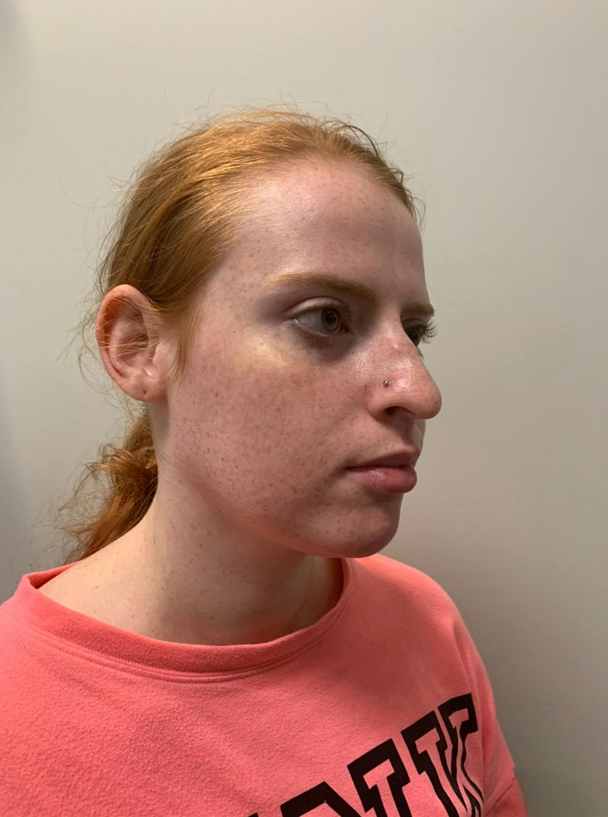 Rhinoplasty Before & After Gallery - Patient 221782 - Image 5
