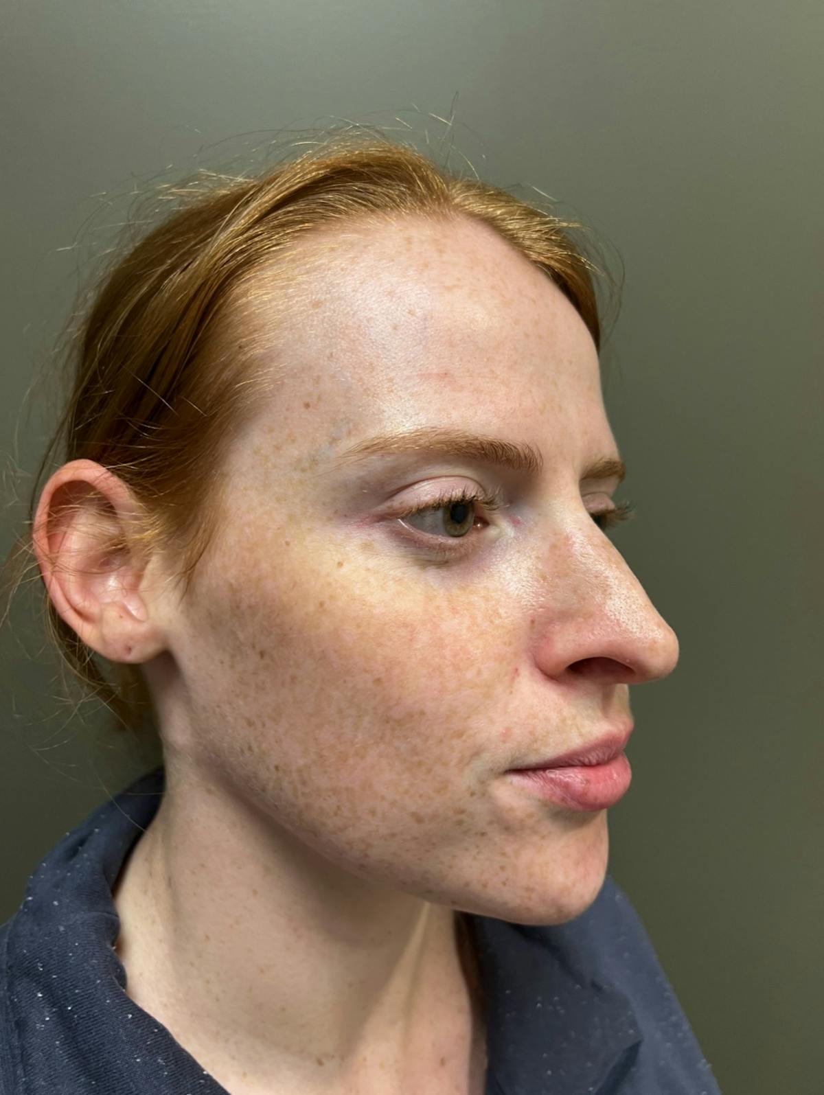 Rhinoplasty Before & After Gallery - Patient 221782 - Image 6