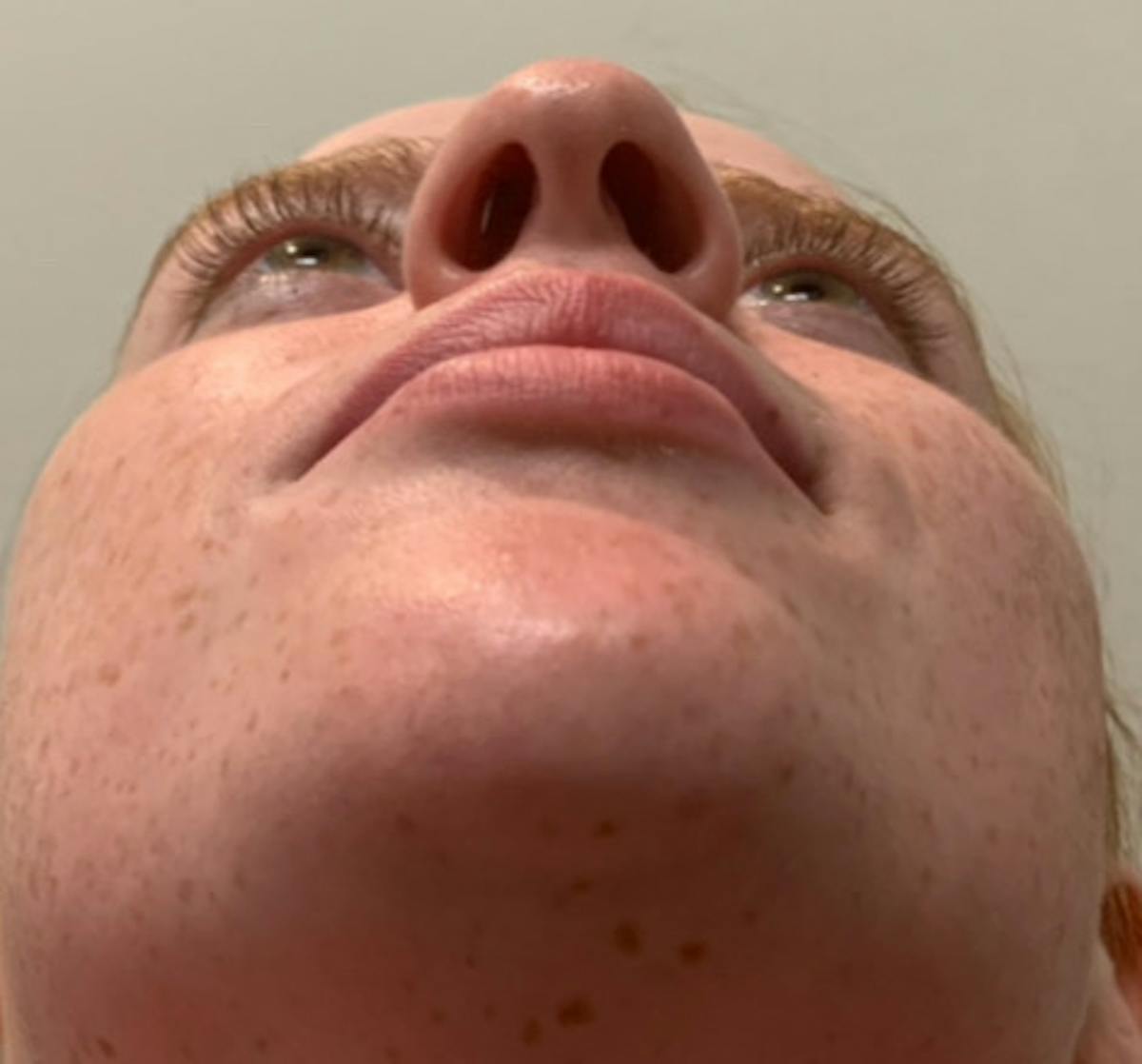 Rhinoplasty Before & After Gallery - Patient 221782 - Image 7