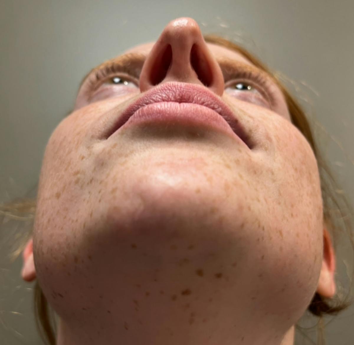 Rhinoplasty Before & After Gallery - Patient 221782 - Image 8