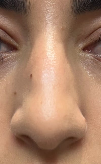 Rhinoplasty Before & After Gallery - Patient 345891 - Image 1