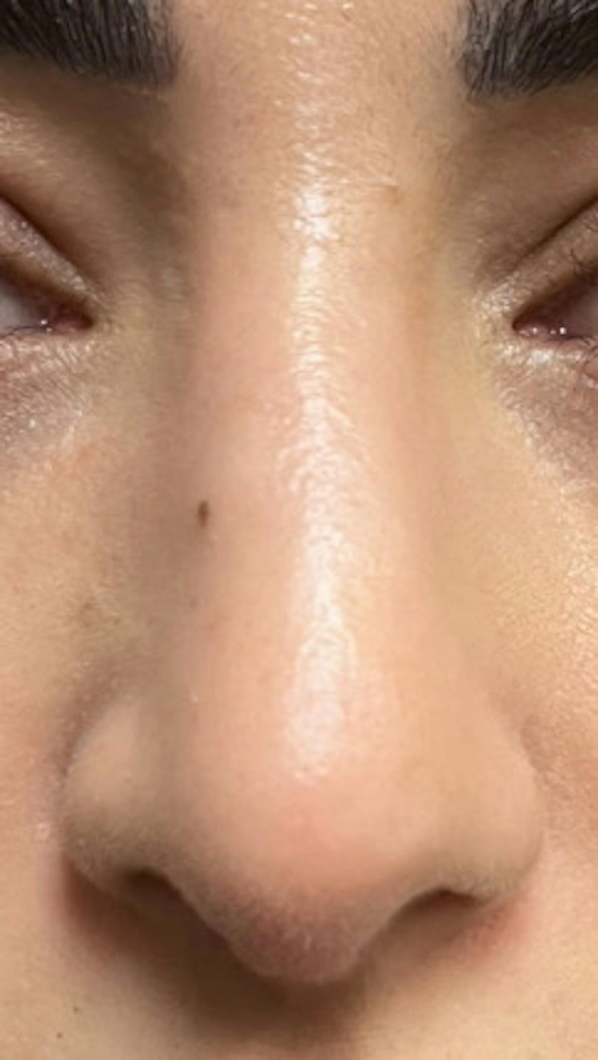 Rhinoplasty Before & After Gallery - Patient 345891 - Image 2