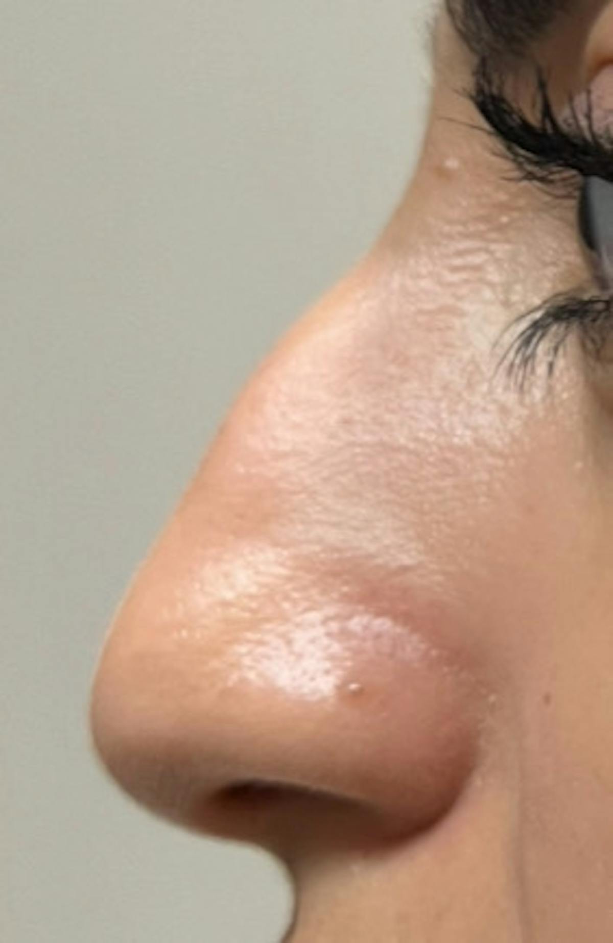 Rhinoplasty Before & After Gallery - Patient 345891 - Image 3