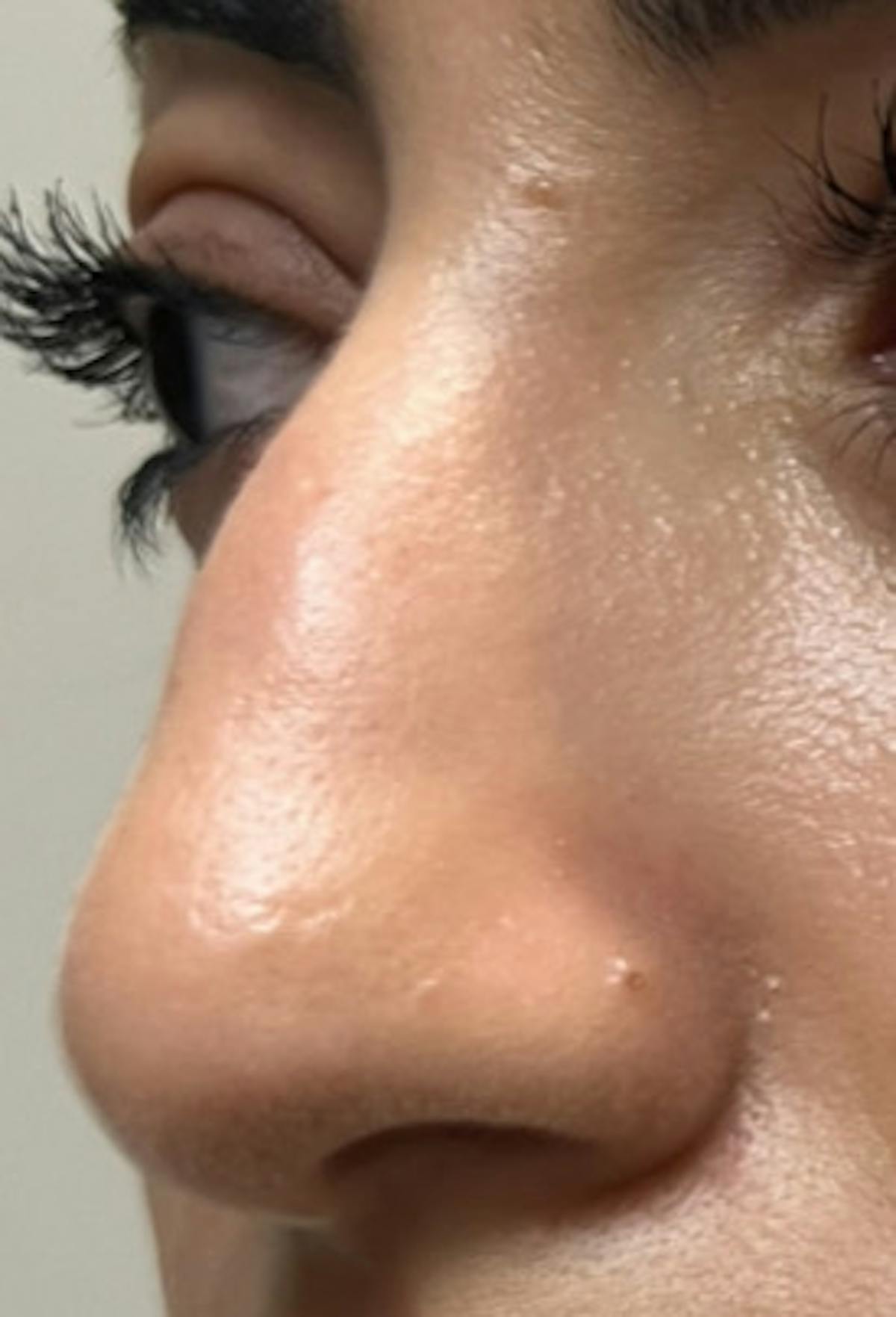 Rhinoplasty Before & After Gallery - Patient 345891 - Image 5
