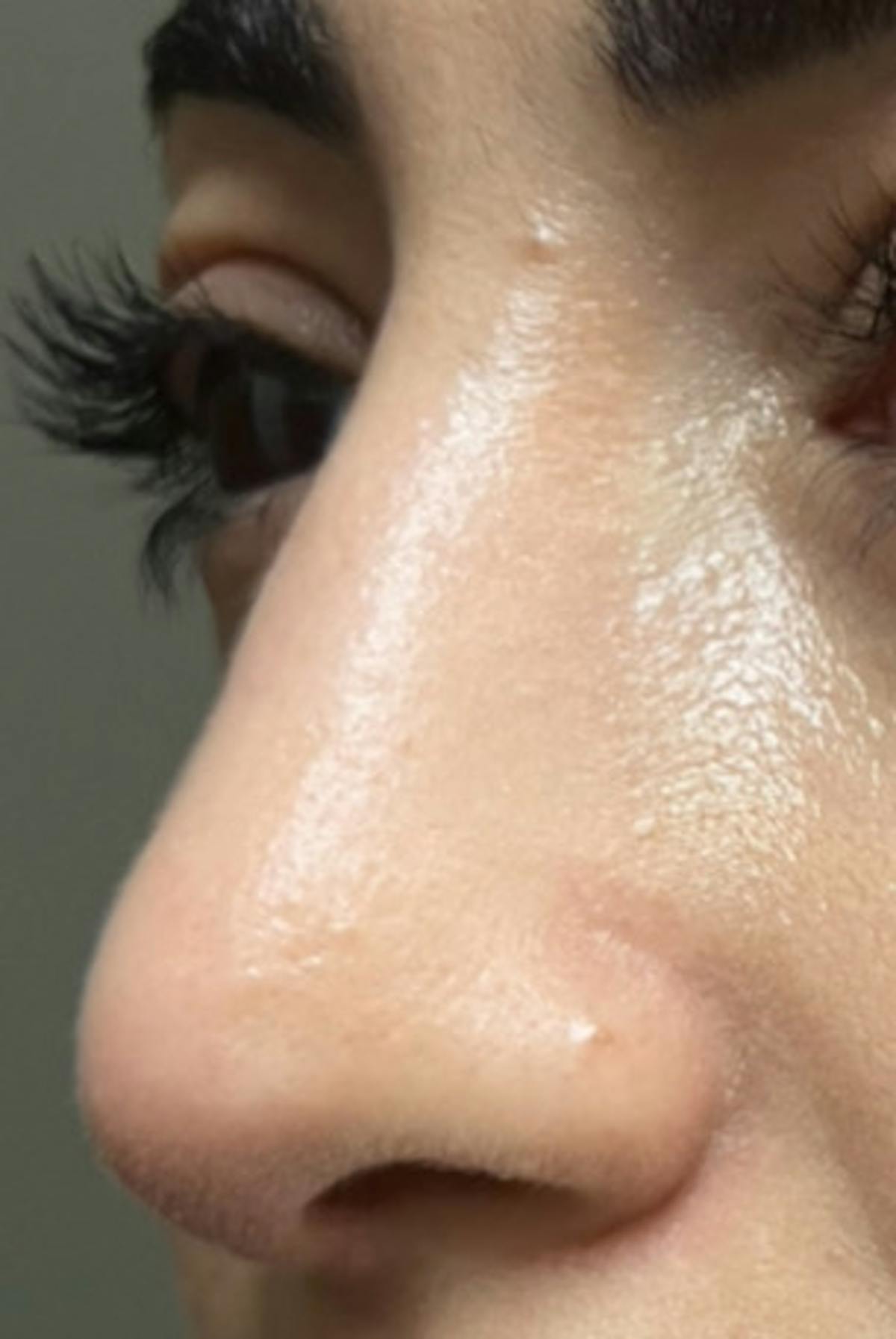 Rhinoplasty Before & After Gallery - Patient 345891 - Image 6