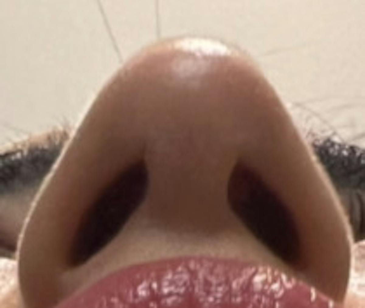 Rhinoplasty Before & After Gallery - Patient 345891 - Image 7