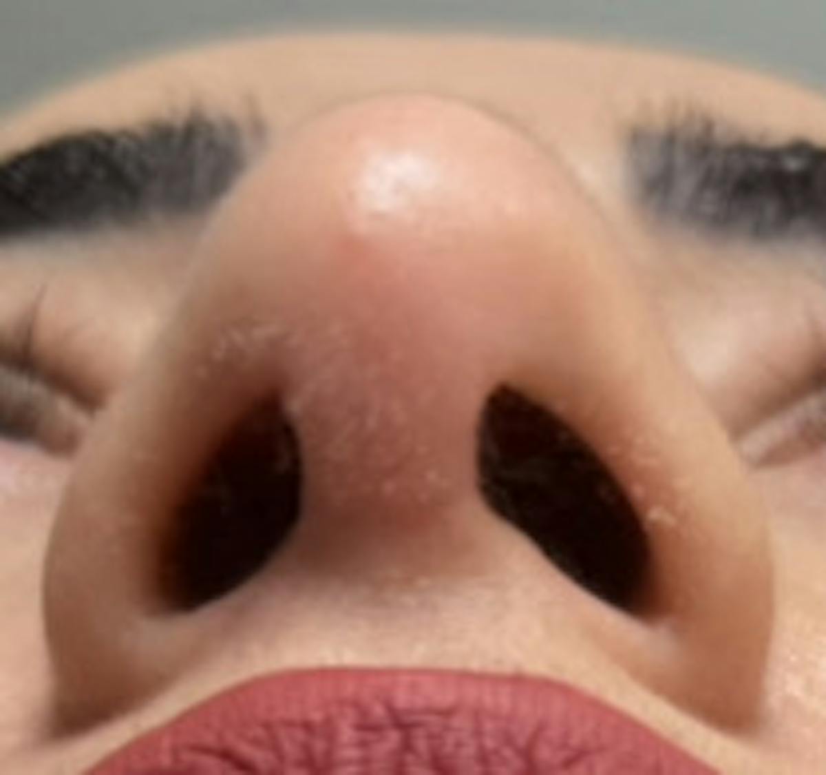 Rhinoplasty Before & After Gallery - Patient 345891 - Image 8