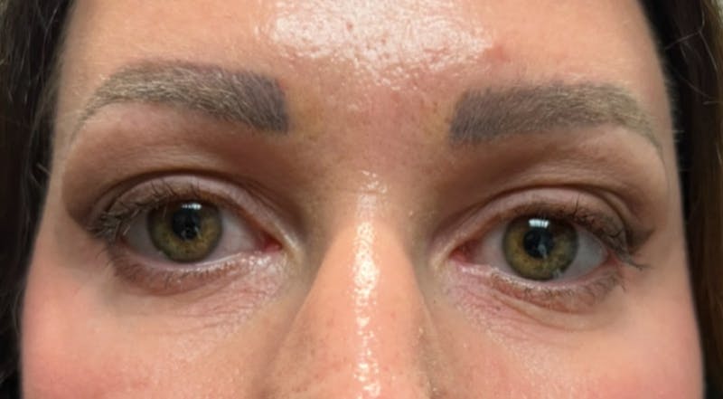 Upper Eyelid Blepharoplasty Before & After Gallery - Patient 751623 - Image 1