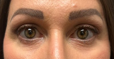 Upper Eyelid Blepharoplasty Before & After Gallery - Patient 751623 - Image 2